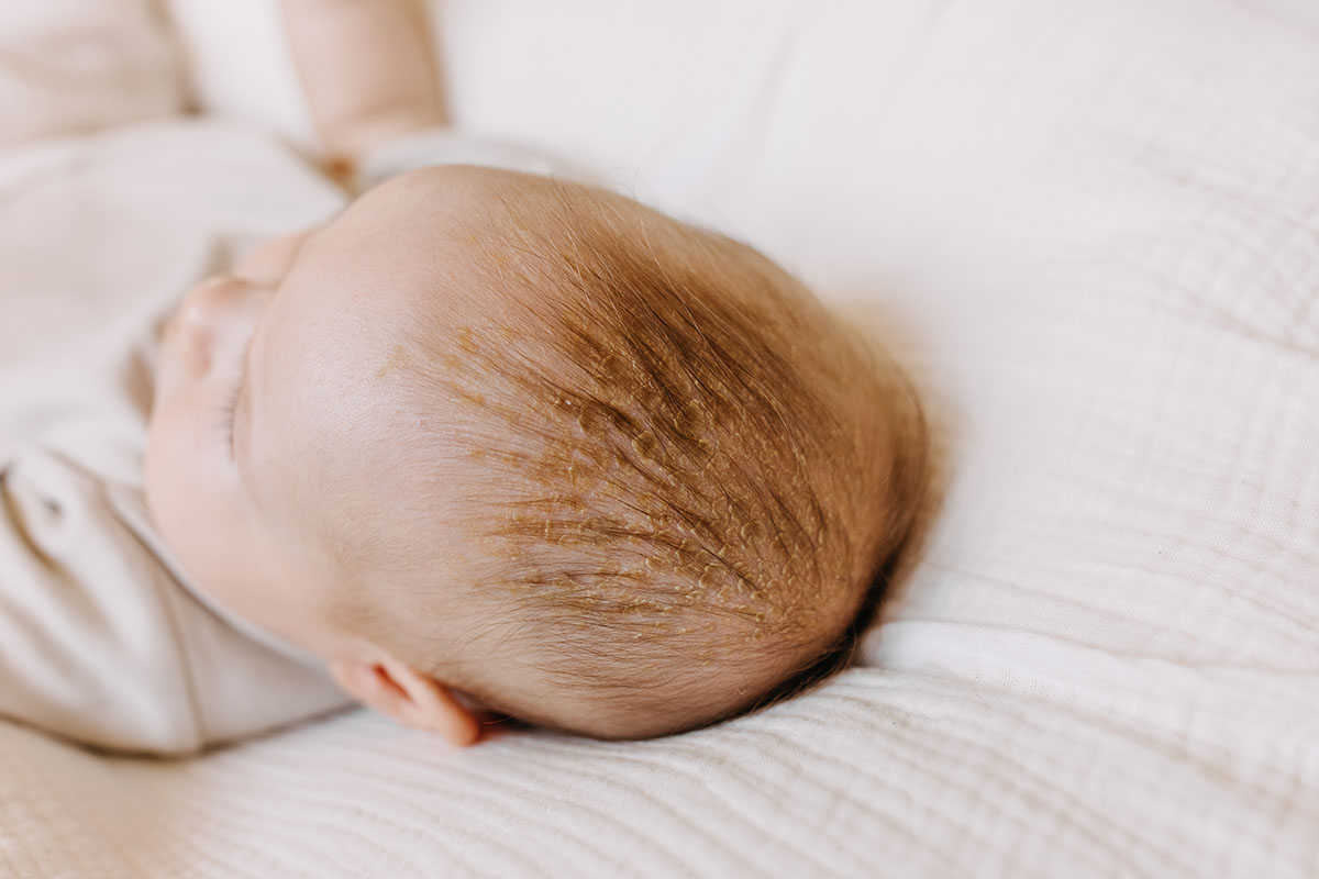 Cradle Cap: Symptoms & Treatment
