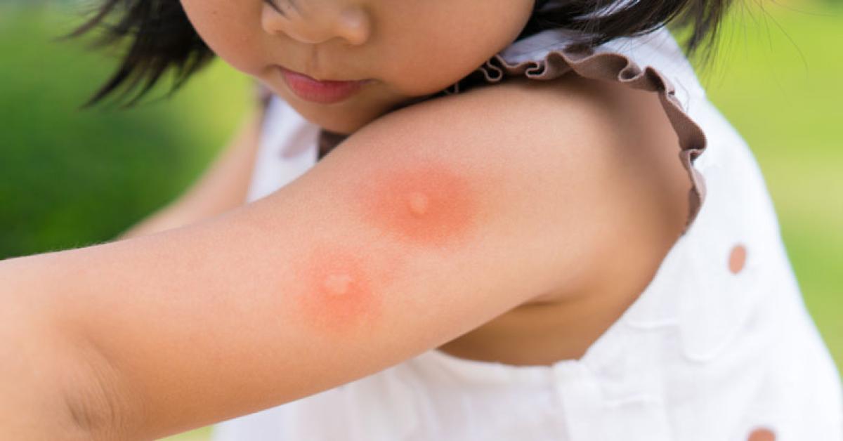 Ways to Prevent & Treat Mosquito Bites in Children