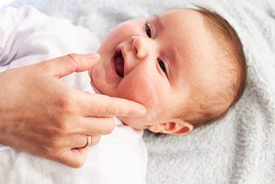 All About Baby Eczema: Causes, Symptoms & Treatments