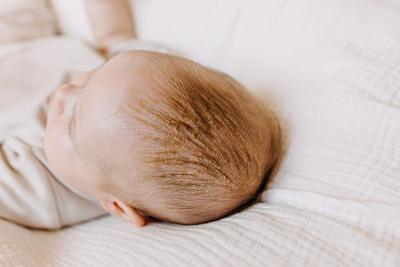 Cradle Cap: Symptoms & Treatment